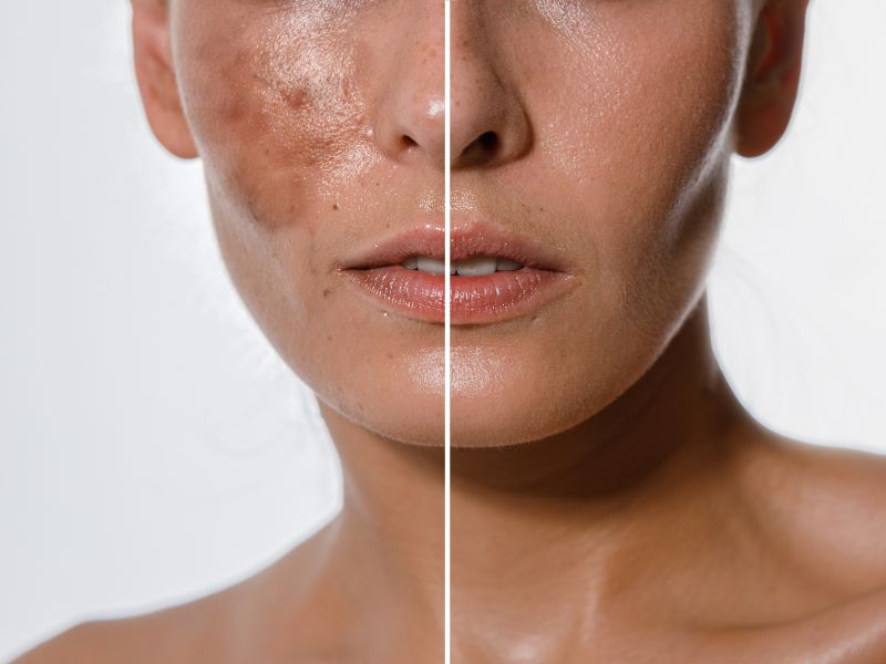 chemical peels treatements in oak lawn