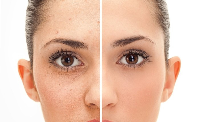 co2 laser recovery