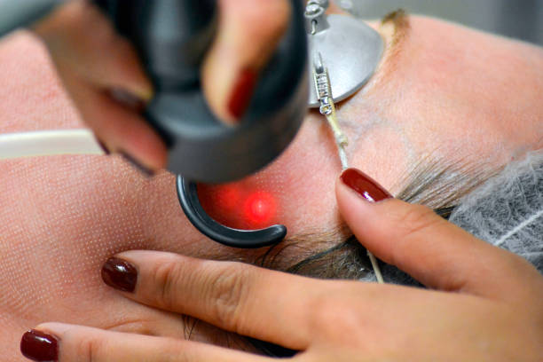 fractional c02 laser treatment in oak lawn