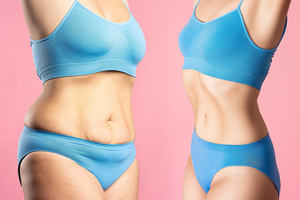 liposuction in oak lawn